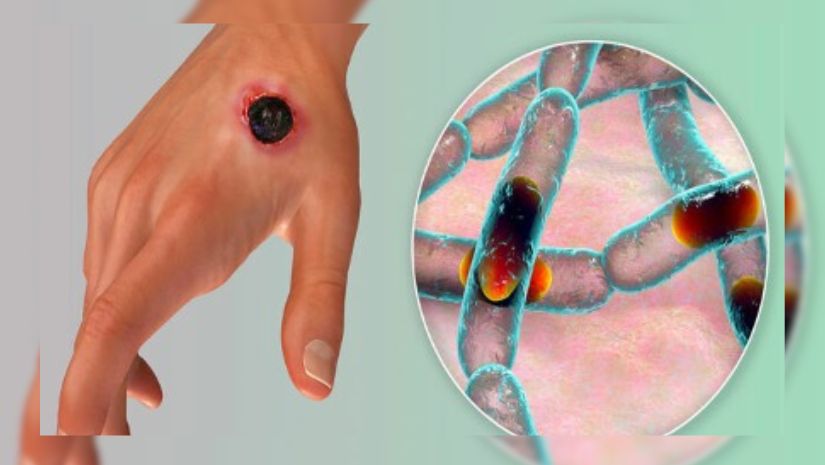 এনথ্রাক্স ছড়ানোর কারণ ও প্রতিকার